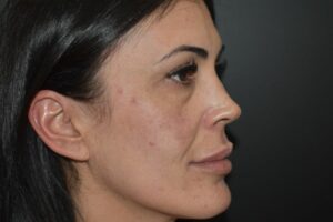 Antes y después de cirugía estética facial