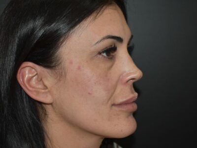 Antes y después de cirugía estética facial