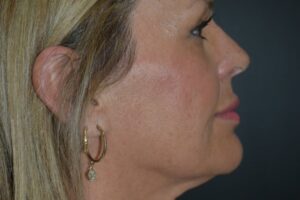 Antes y después de cirugía estética facial