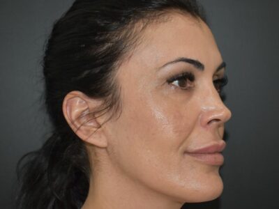 Antes y después de cirugía estética facial