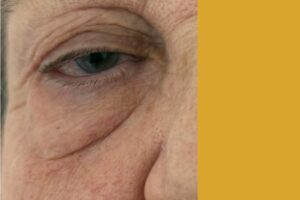 Blefaroroplastia Superior antes y después