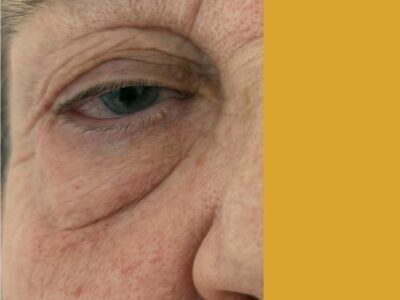 Blefaroroplastia Superior antes y después