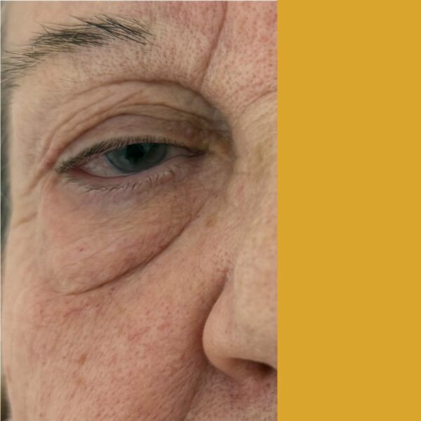 Blefaroroplastia Superior antes y después