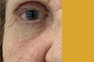 Blefaroroplastia Superior antes y después