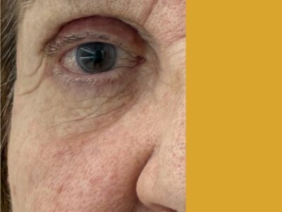 Blefaroroplastia Superior antes y después