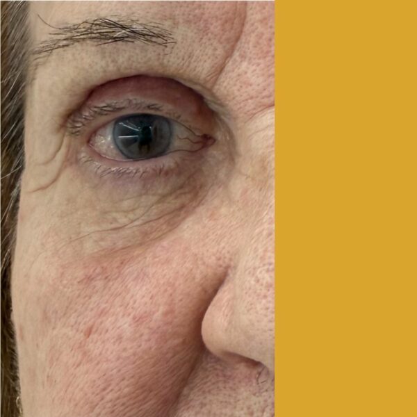 Blefaroroplastia Superior antes y después