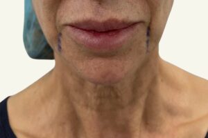 Antes y después de minilifting facial