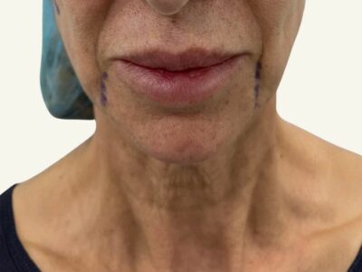 Antes y después de minilifting facial