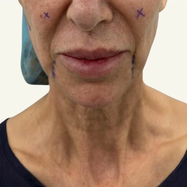 Antes y después de minilifting facial