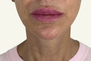 Antes y después de minilifting facial