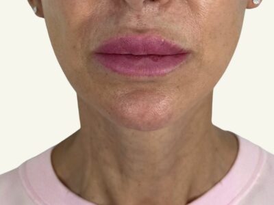 Antes y después de minilifting facial