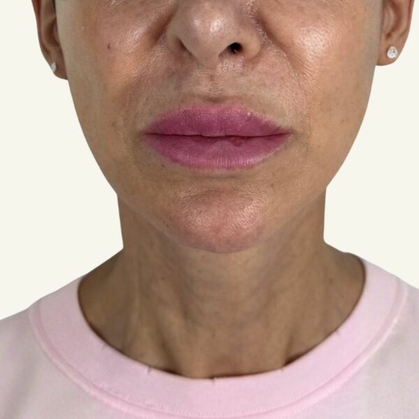 Antes y después de minilifting facial