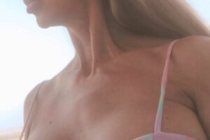 Minilifting de cara y cuello un año después - Dra. Gutierrez Sumillera - Murcia y Alicante Minilifting de cara y cuello un año después - Dra. Gutierrez Sumillera - Murcia y Alicante